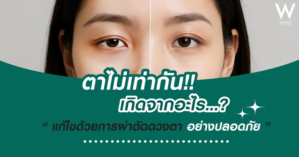 ตาไม่เท่ากัน เกิดจากอะไร แก้ไขด้วยการผ่าตัดดวงตาอย่างปลอดภัย