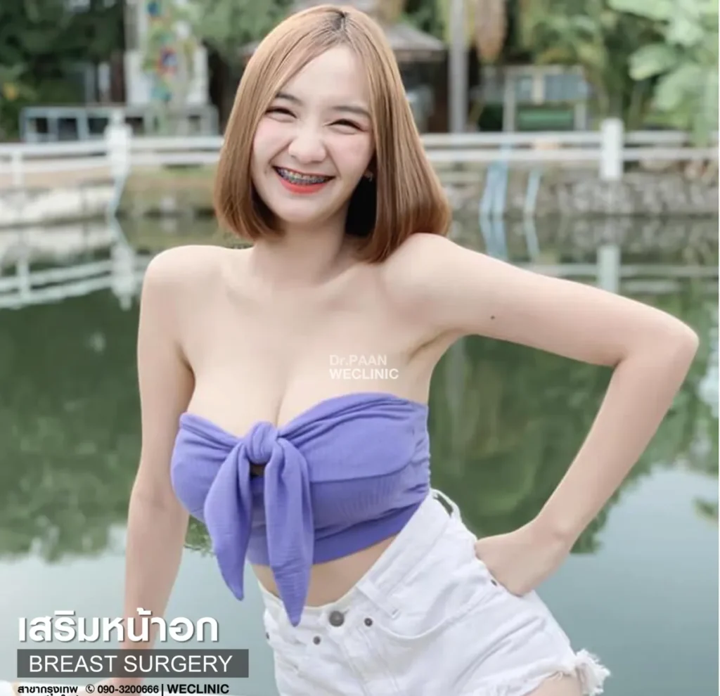 breast-augmentation-300cc-review-casual