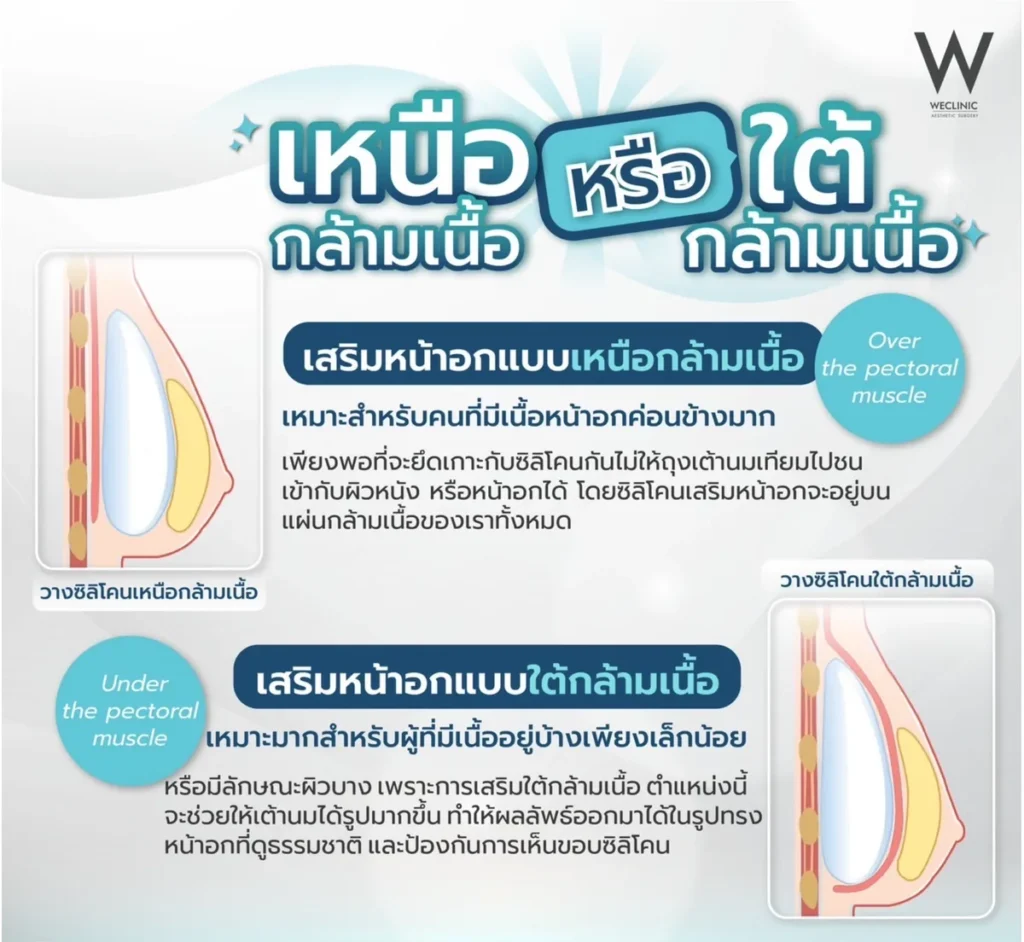 breast-augmentation-over-vs-under-muscle