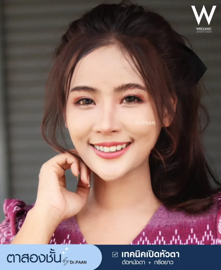 medial-epicanthoplasty-double-eyelid-surgery-result