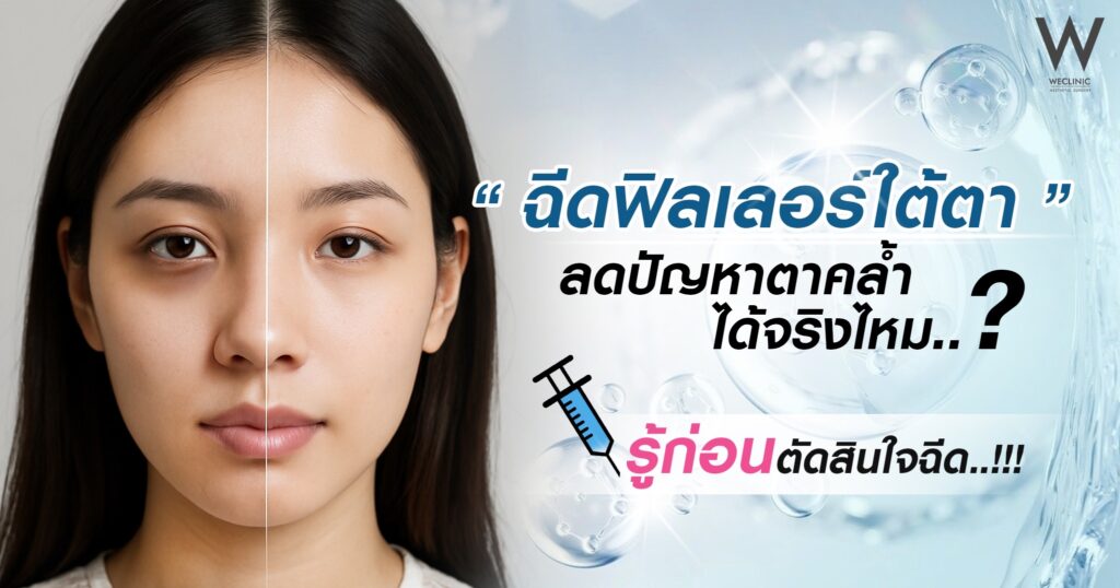ฟิลเลอร์ใต้ตา ลดปัญหาใต้ตาคล้ำ