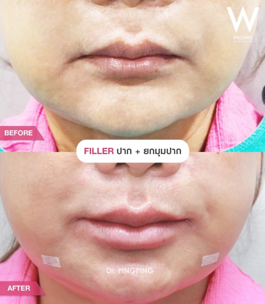 คนที่มีปัญหาริมฝีปากจากอายุหรือสภาพผิวเหมาะกับฉีดฟิลเลอร์