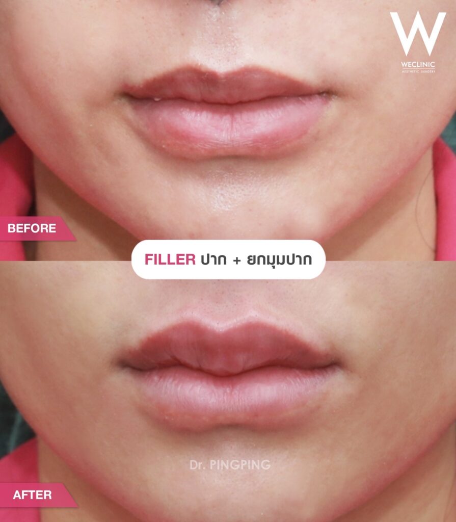คนที่อยากเสริมบุคลิกภาพและความมั่นใจควรฉีด Filler