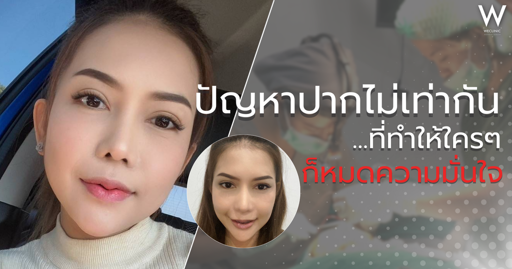 ปากไม่เท่ากัน ดูอย่างไร สาเหตุ วิธีแก้ไข ให้เกิดความมั่นใจ