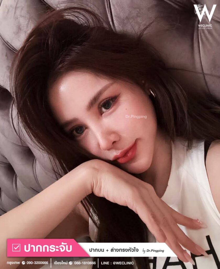 รีวิวการฉีดฟิลเลอร์ปากกระจับ