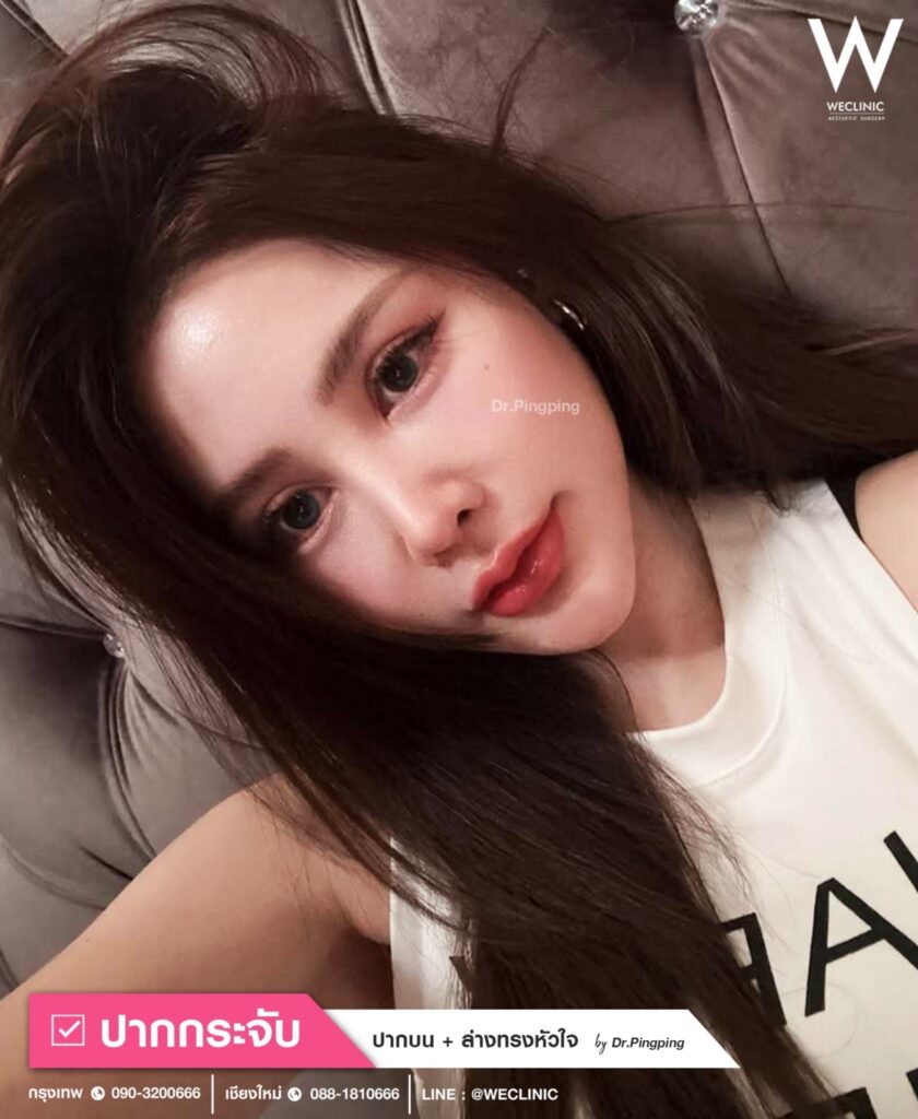 เติม Filler รีวิวฉีดปากกระจับ