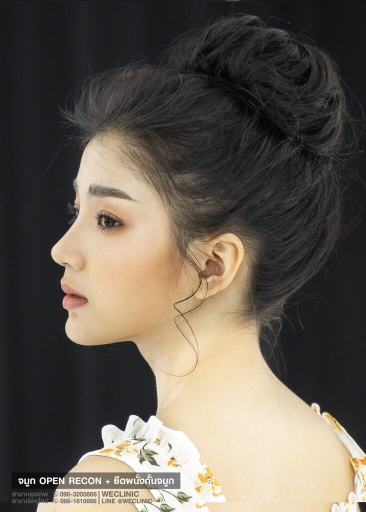 เสริมจมูกทรงใบเฟิร์นหันข้าง