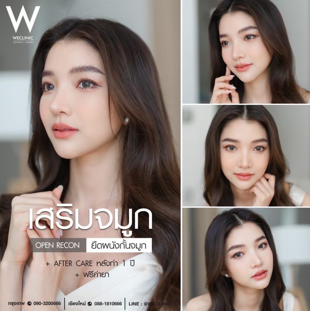 เสริมจมูกทรงใบเฟิร์นเทคนิคเปิด