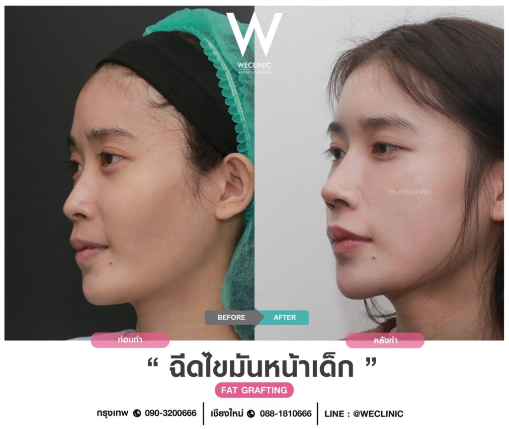 ข้อดีของการฉีดไขมันแก้แก้มตอบ