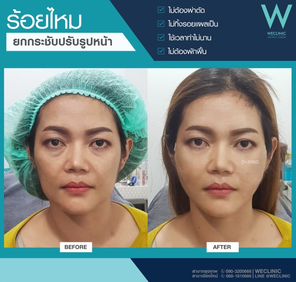 ร้อยไหมแก้ไขแก้มตอบ