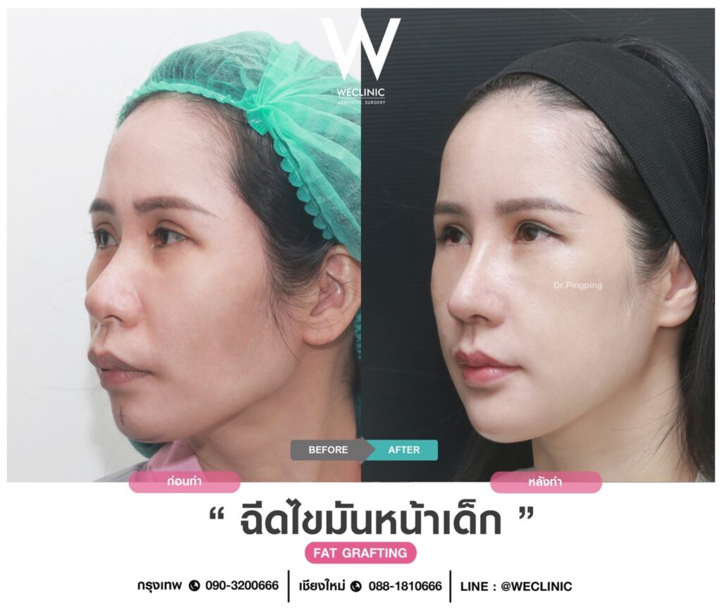 สาเหตุที่แก้มตอบ