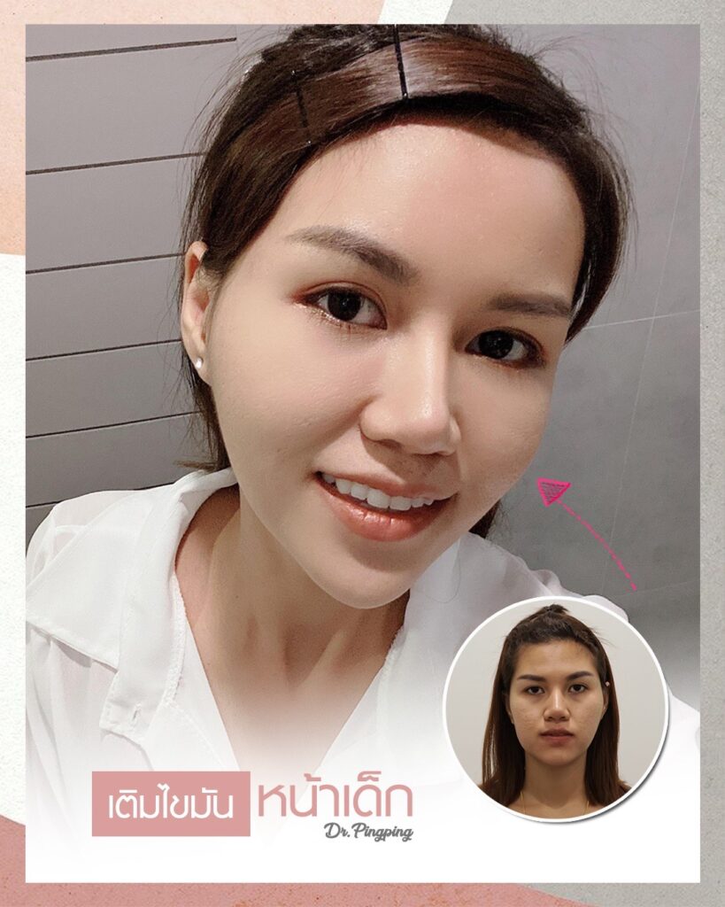 เติมไขมันหน้าเด็ก เหมาะกับใคร