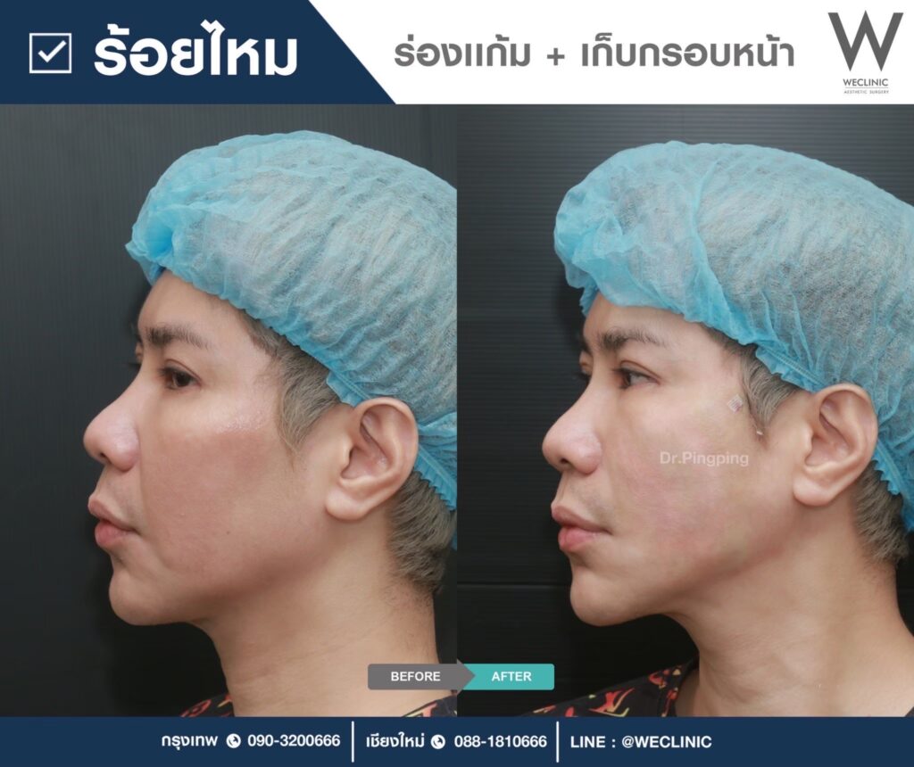 เทคนิคร้อยไหมแก้ไขแก้มตอบ 