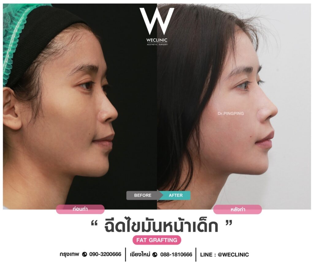 แก้มตอบ ขมับตอบมีผลต่อโหงวเฮ้งอย่างไร