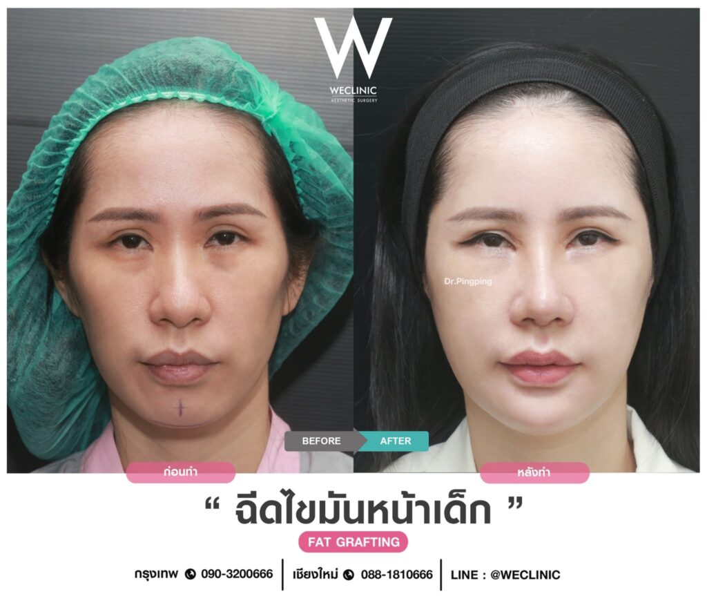 แก้แก้มตอบฉีดไขมันหน้าเด็ก