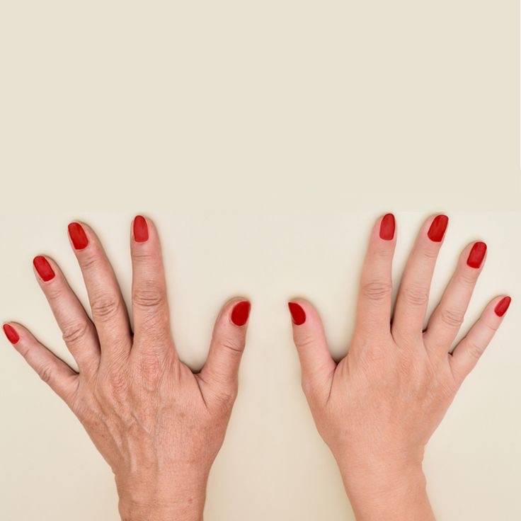 การฉีดฟิลเลอร์หลังมือแก้มือเหี่ยว