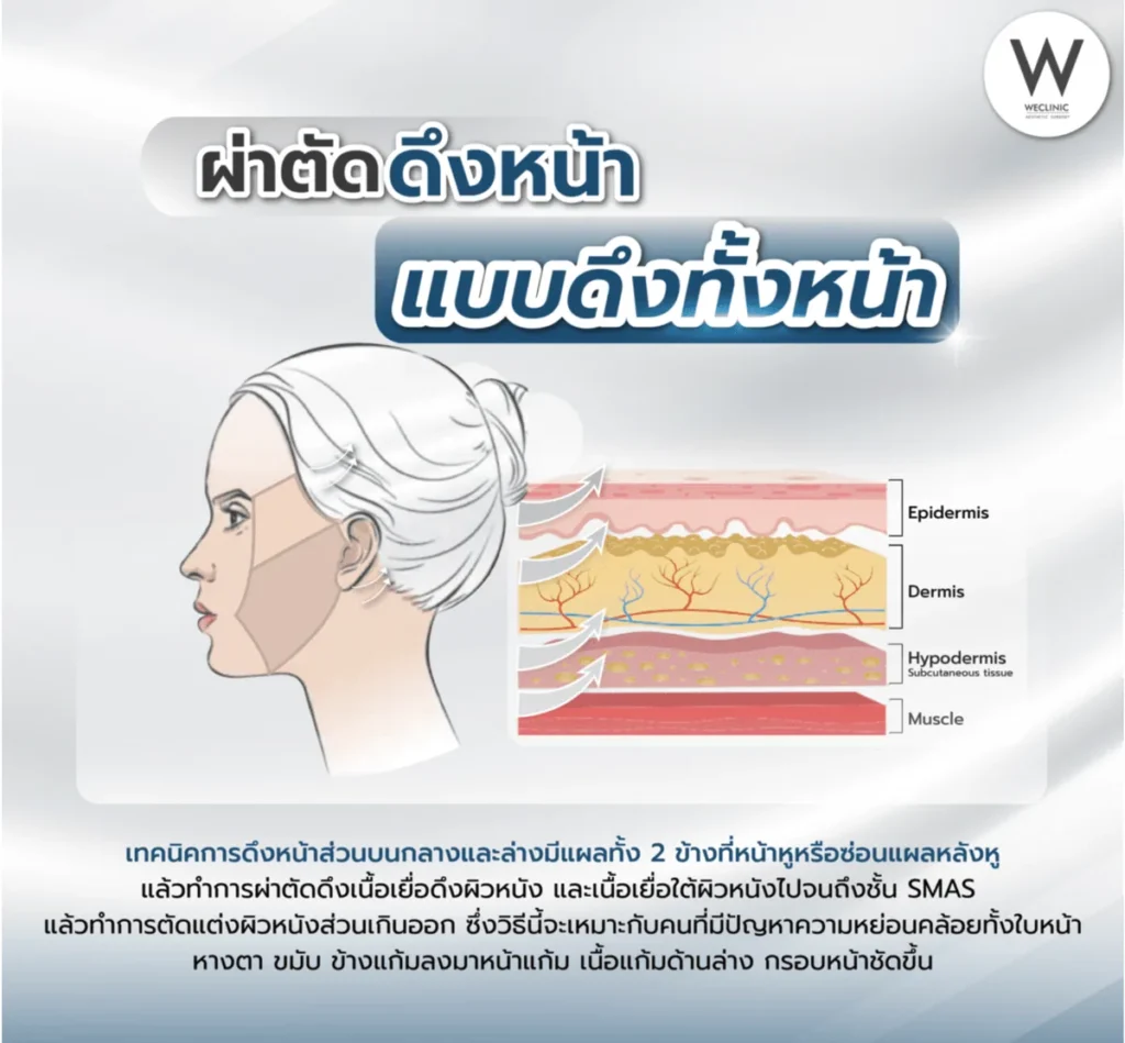 facelift-surgery-full-face