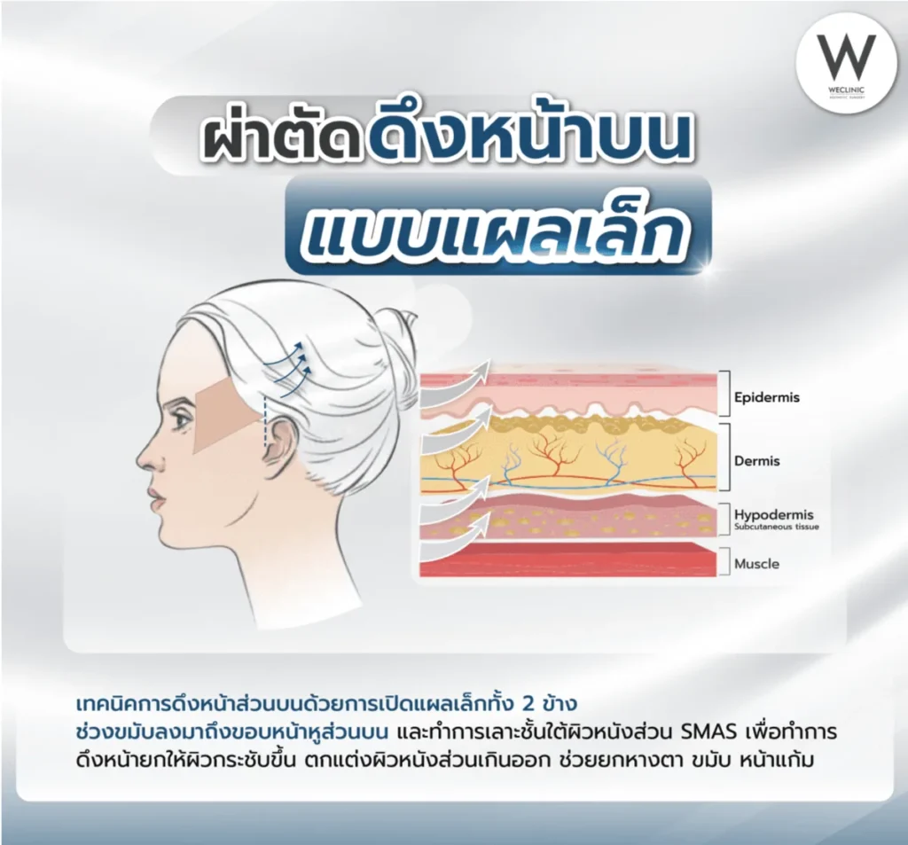 facelift-surgery-upper-mini-incision