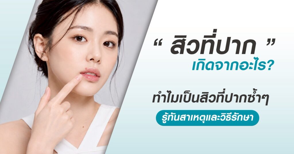 สิวที่ปาก เกิดจากอะไร รักษาอย่างไร และป้องกันยังไงกลับมาเป็นซ้ำ