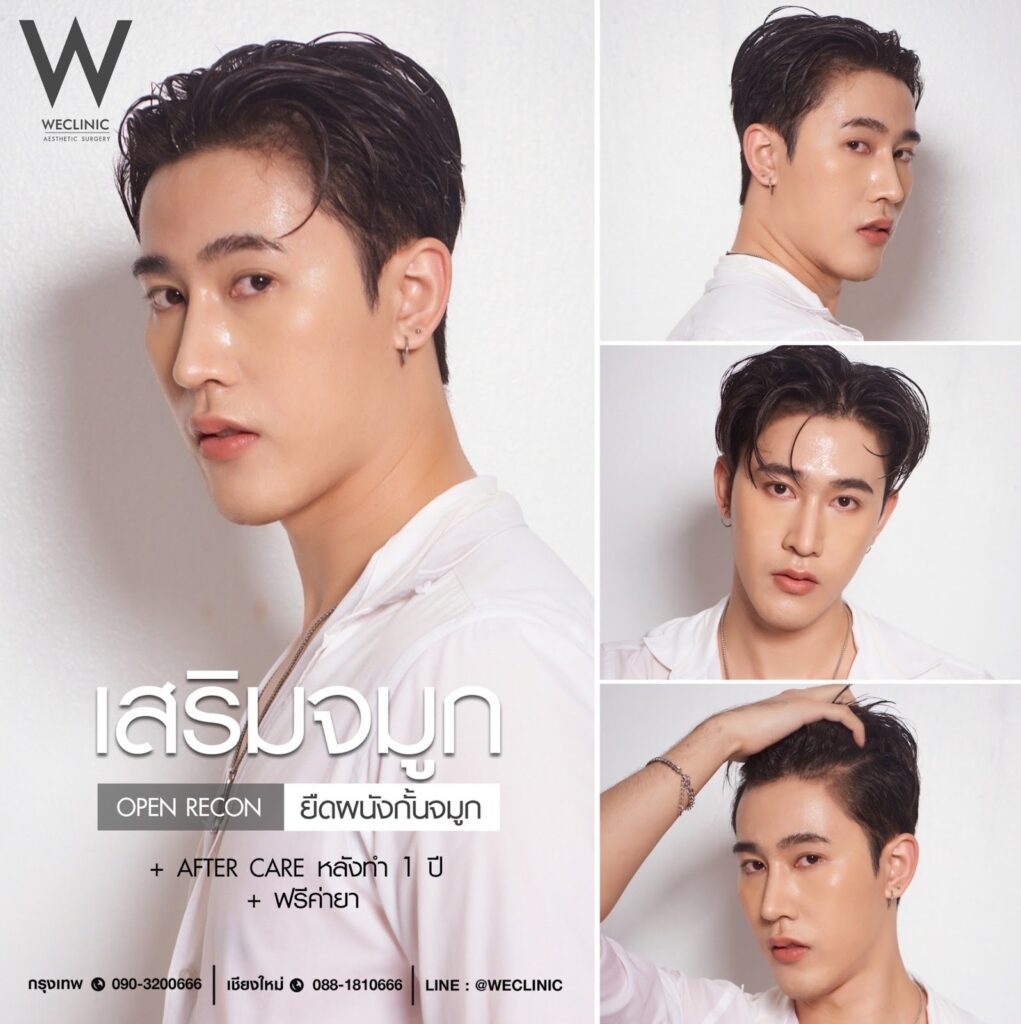รีวิวทำจมูกผู้ชายเสริมโอเพ่น