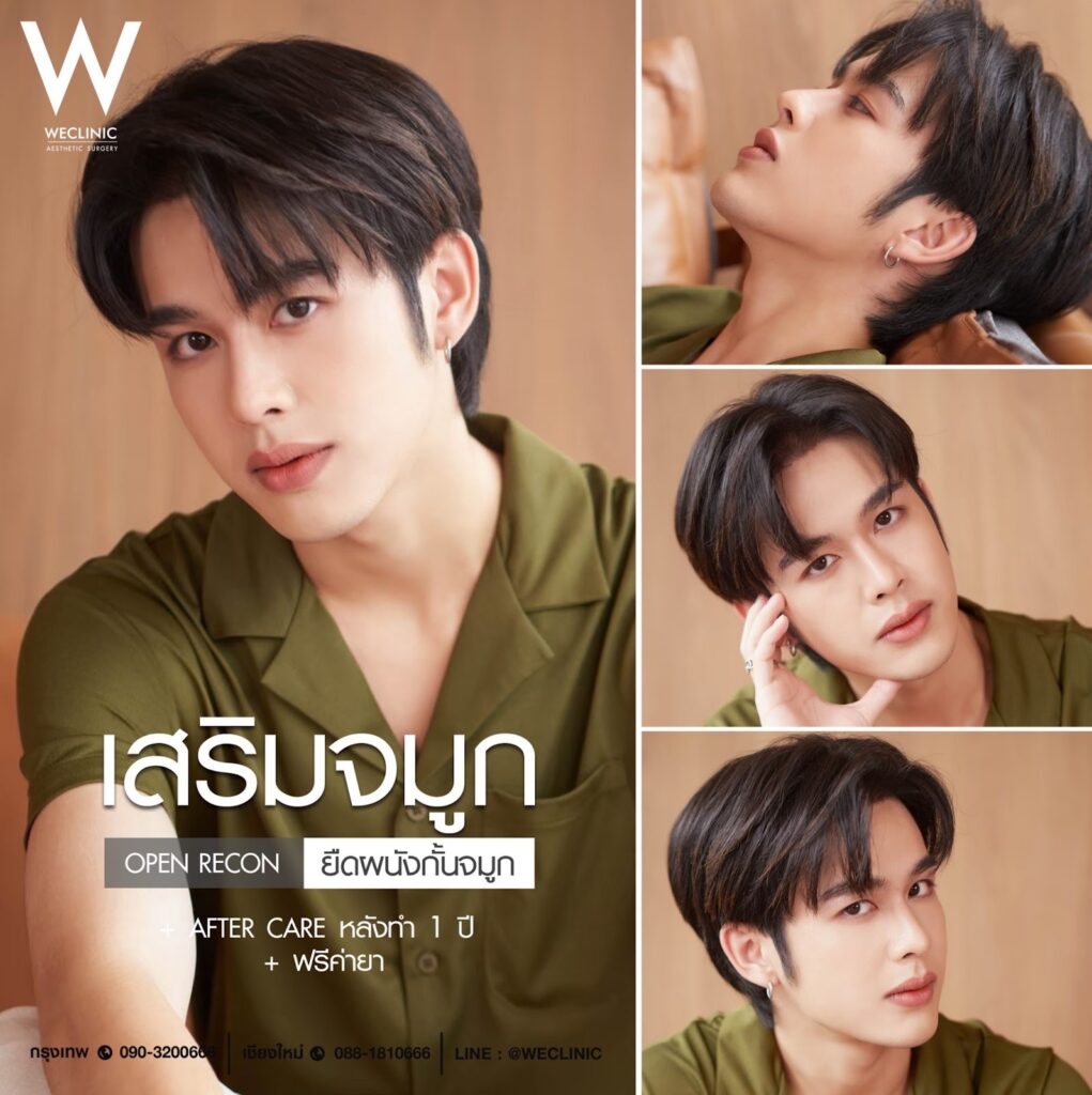 รีวิวเสริมจมูกผู้ชาย Open