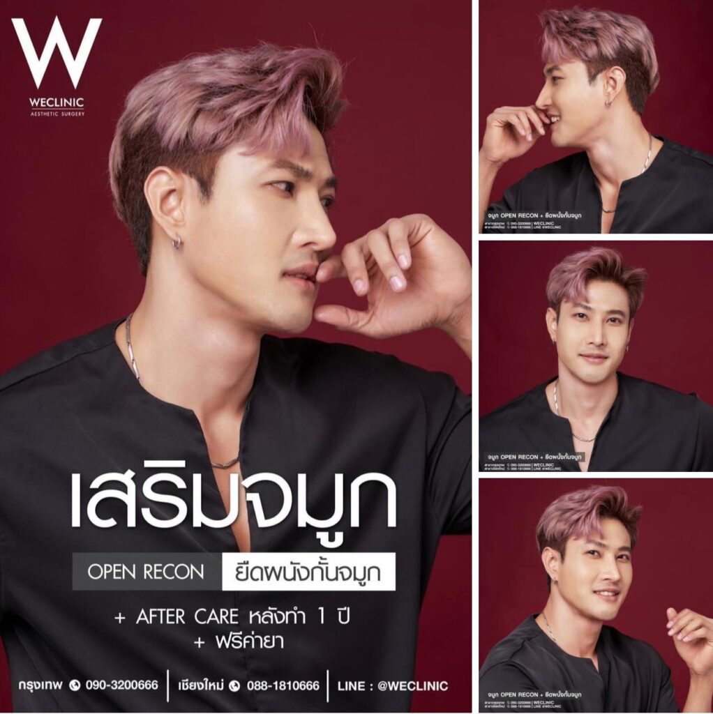 รีวิวเสริมจมูกโอเพ่นผู้ชาย