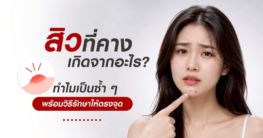 สิวที่คางเกิดจากอะไร? ทำไมเป็นซ้ำ ๆ พร้อมวิธีรักษาให้ตรงจุด