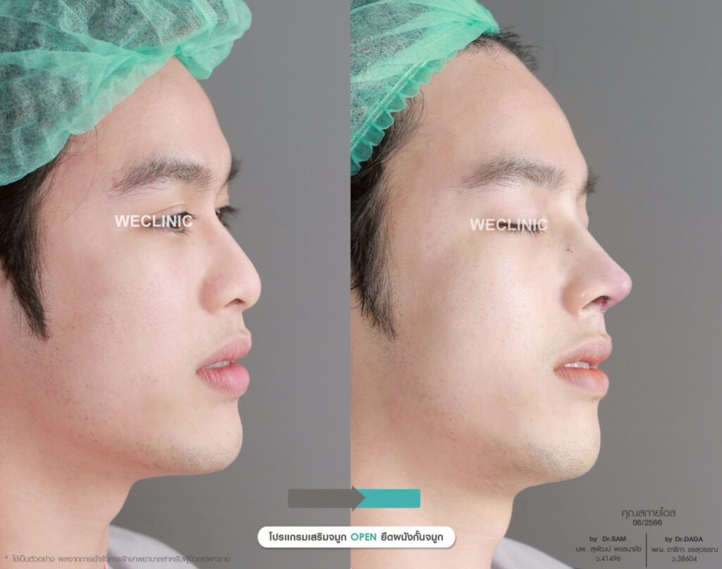 ดั้งแหมบ จมูกแหมบ มีลักษณะอย่างไร