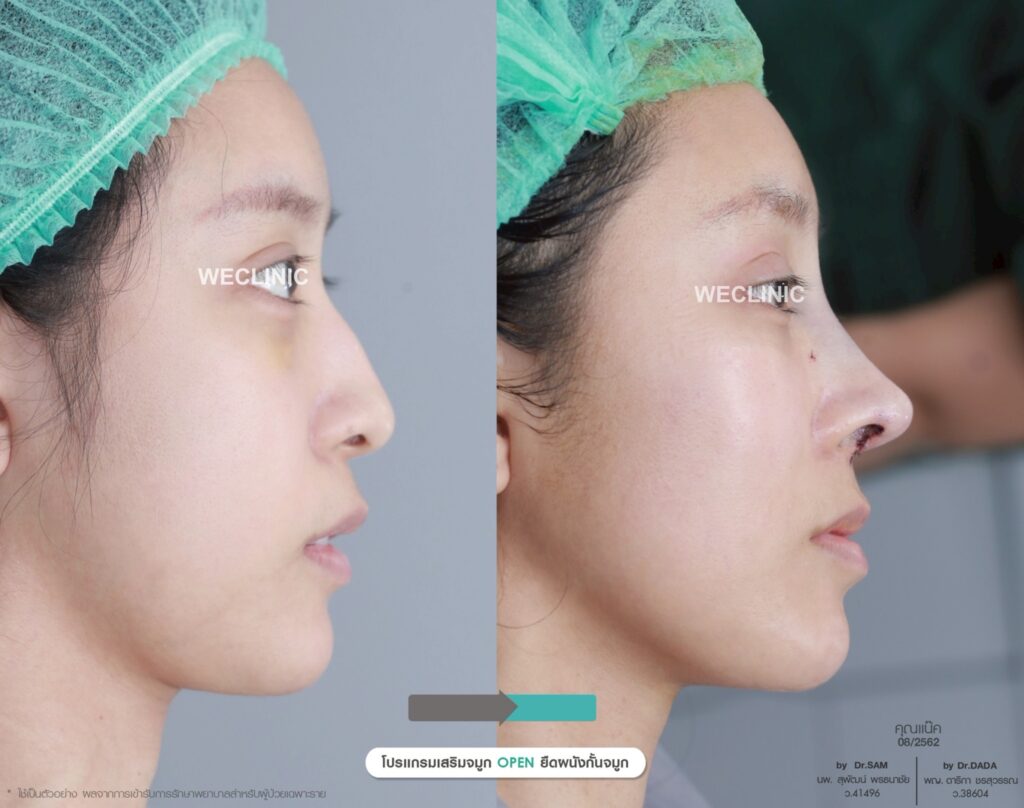 สาเหตุที่ทำให้ดั้งแหมบ มีอะไรบ้าง