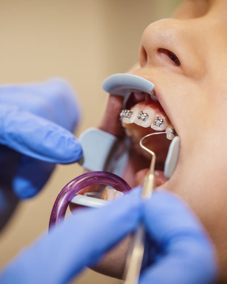 จัดฟันอยู่ ทําจมูกได้ไหม