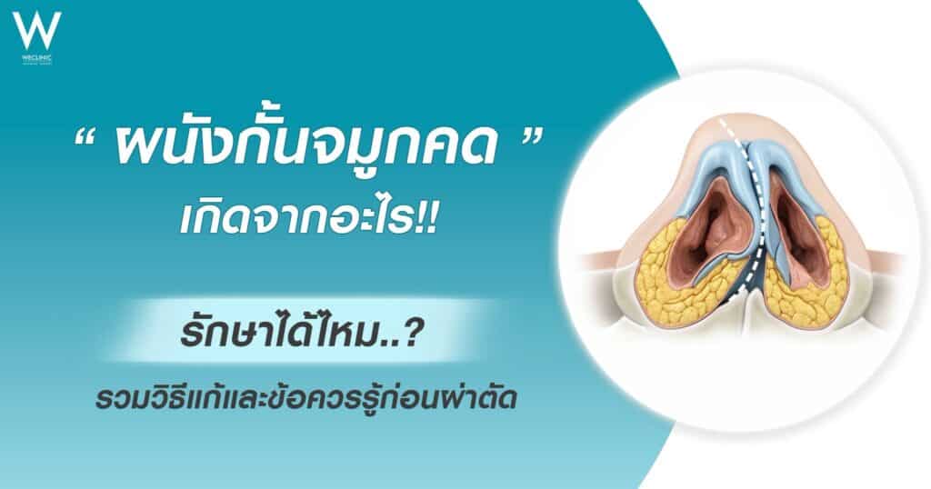 ผนังกั้นจมูกคด