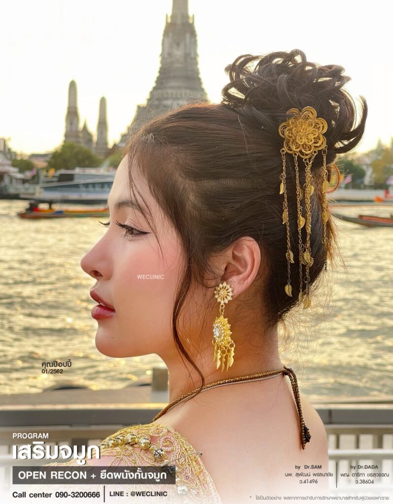 รีวิวเสริมจมูก ปรับโครงสร้างจมูก_ป๊อปปี้