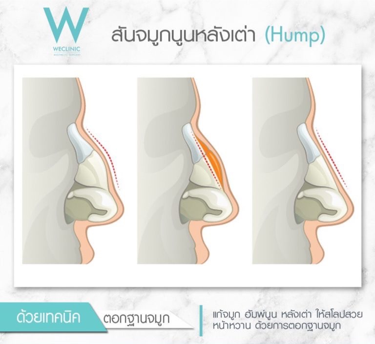 Hump Nose