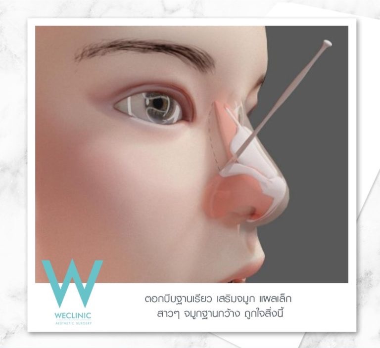 Nasal Osteotomy