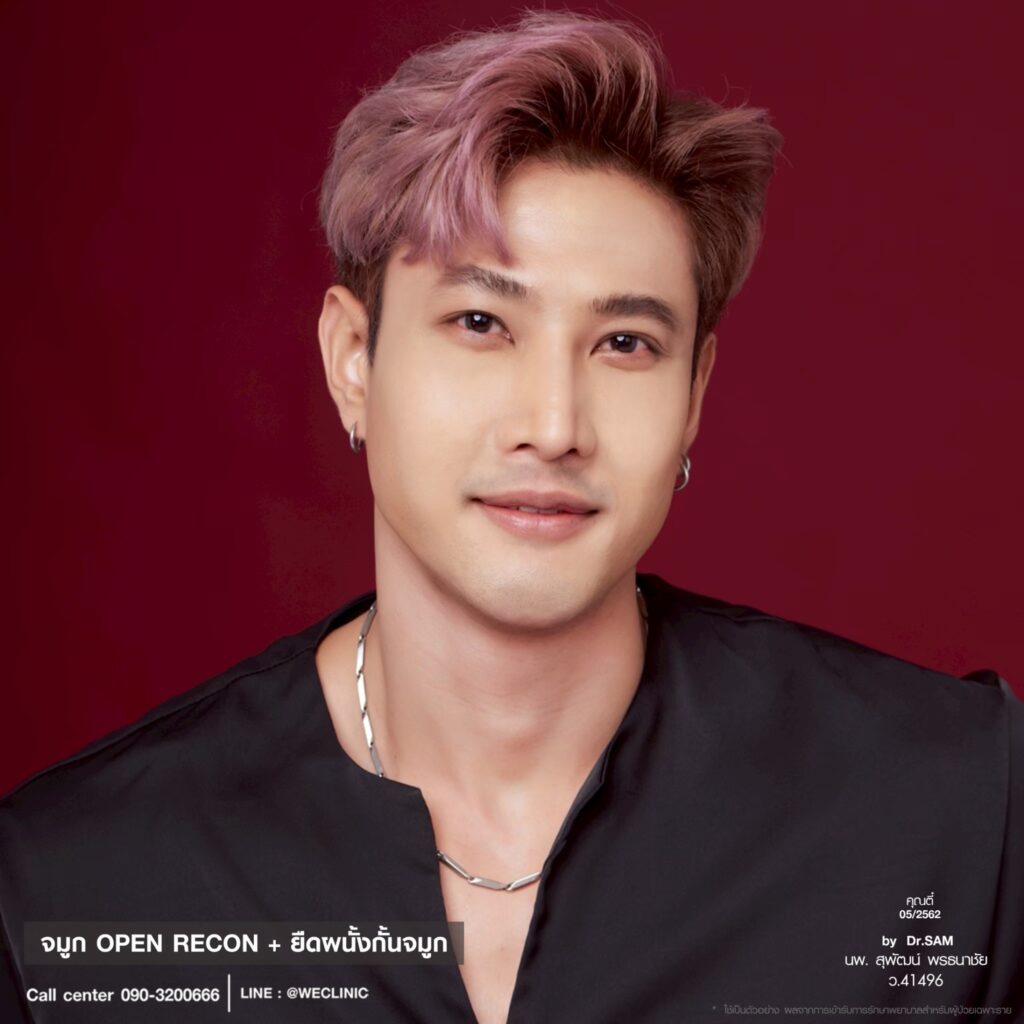 เสริมจมูกผู้ชายแบบโอเพ่น_ตี๋