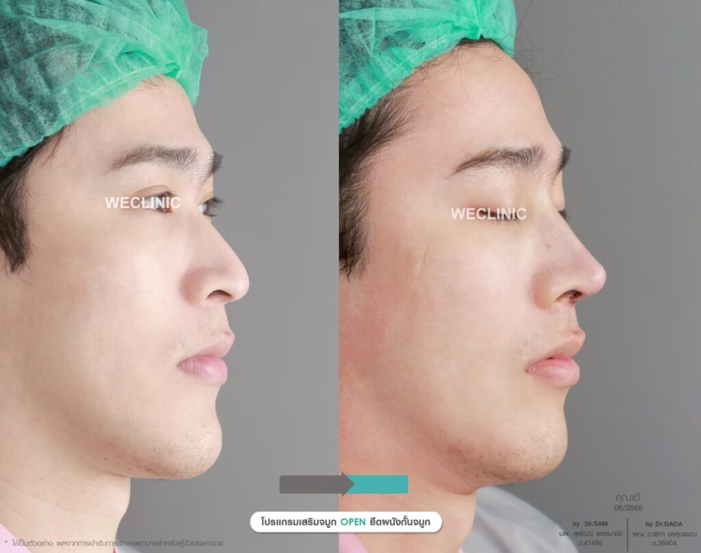 โปรแกรมเสริมจมูก Open