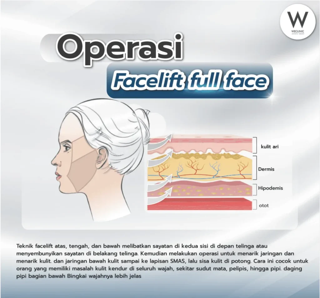 facelift-surgery-full-face-id