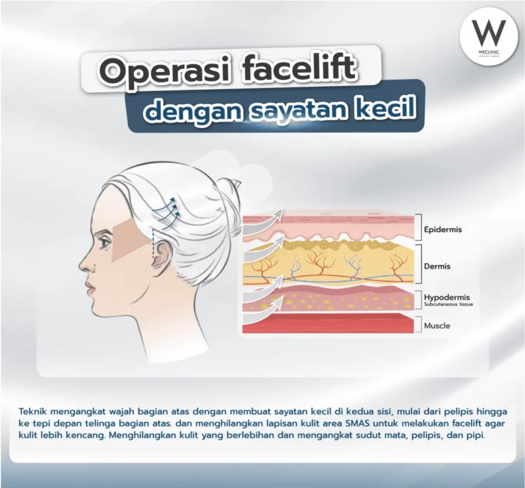facelift-surgery-upper-mini-incision-id
