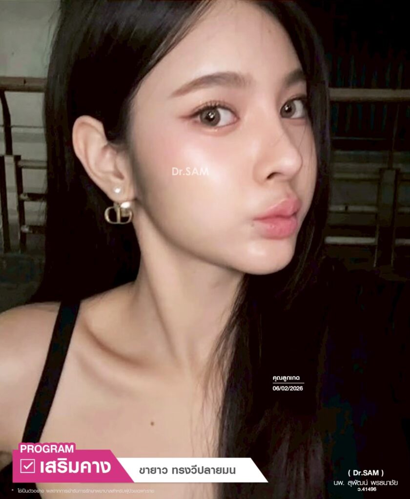 รีวิวการทำคาง_คุณลูกเกด_หมอแซม