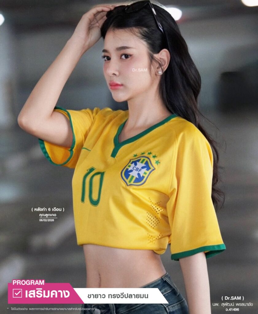 รีวิวคางหลังทำ 6 เดือนทรงวีปลายมน_คุณลูกเกด_หมอแซม