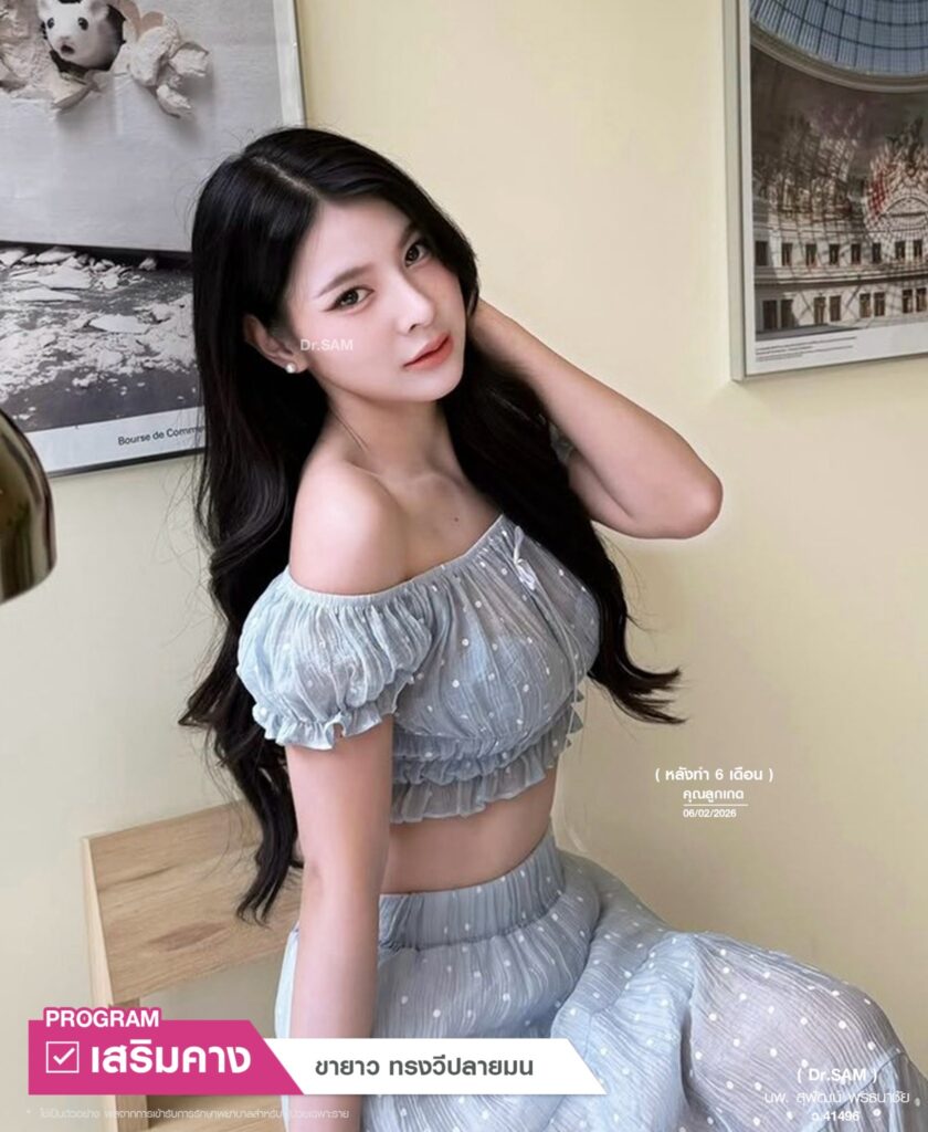 รีวิวทำคางหลังทำ 6 เดือน_คุณลูกเกด_หมอแซม