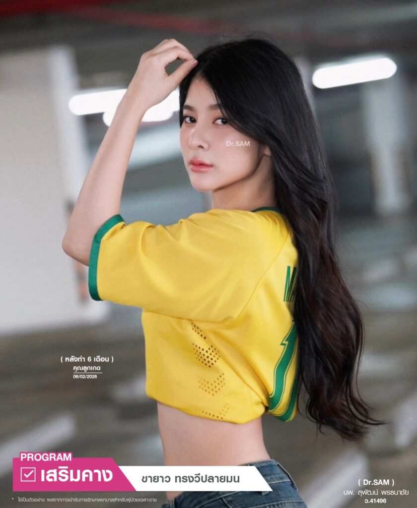 รีวิวศัลยกรรมคางหลังทำ 6 เดือน_คุณลูกเกด_หมอแซม