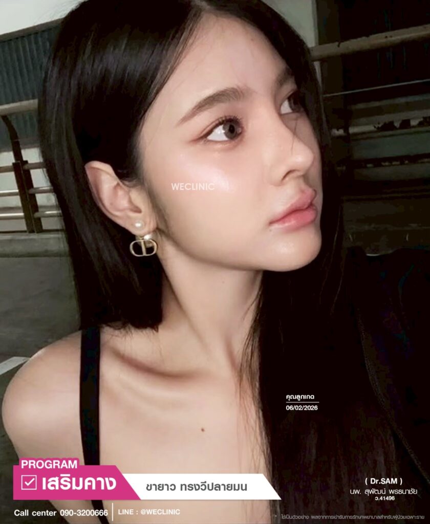 รีวิวเสริมคาง BKK_คุณลูกเกด_หมอแซม