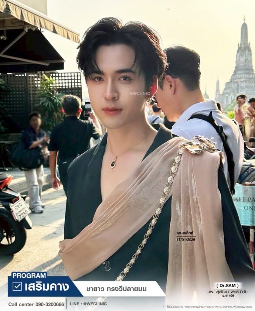 รีวิวเสริมคาง BKK_คุณอเล็กซ์_หมอแซม