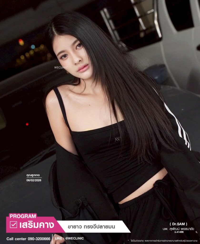 รีวิวเสริมคางทรงวีปลายมน_คุณลูกเกด_หมอแซม