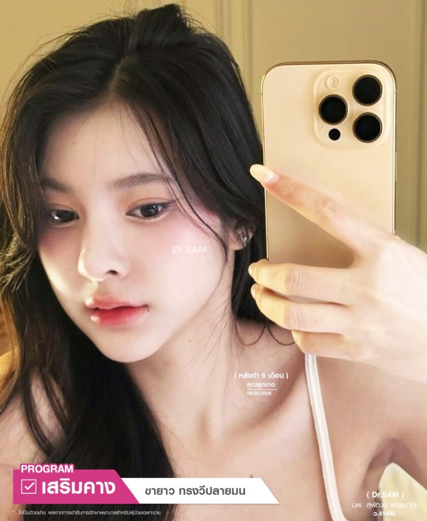 รีวิวเสริมคางหลังทำ 6 เดือน_คุณลูกเกด_หมอแซม