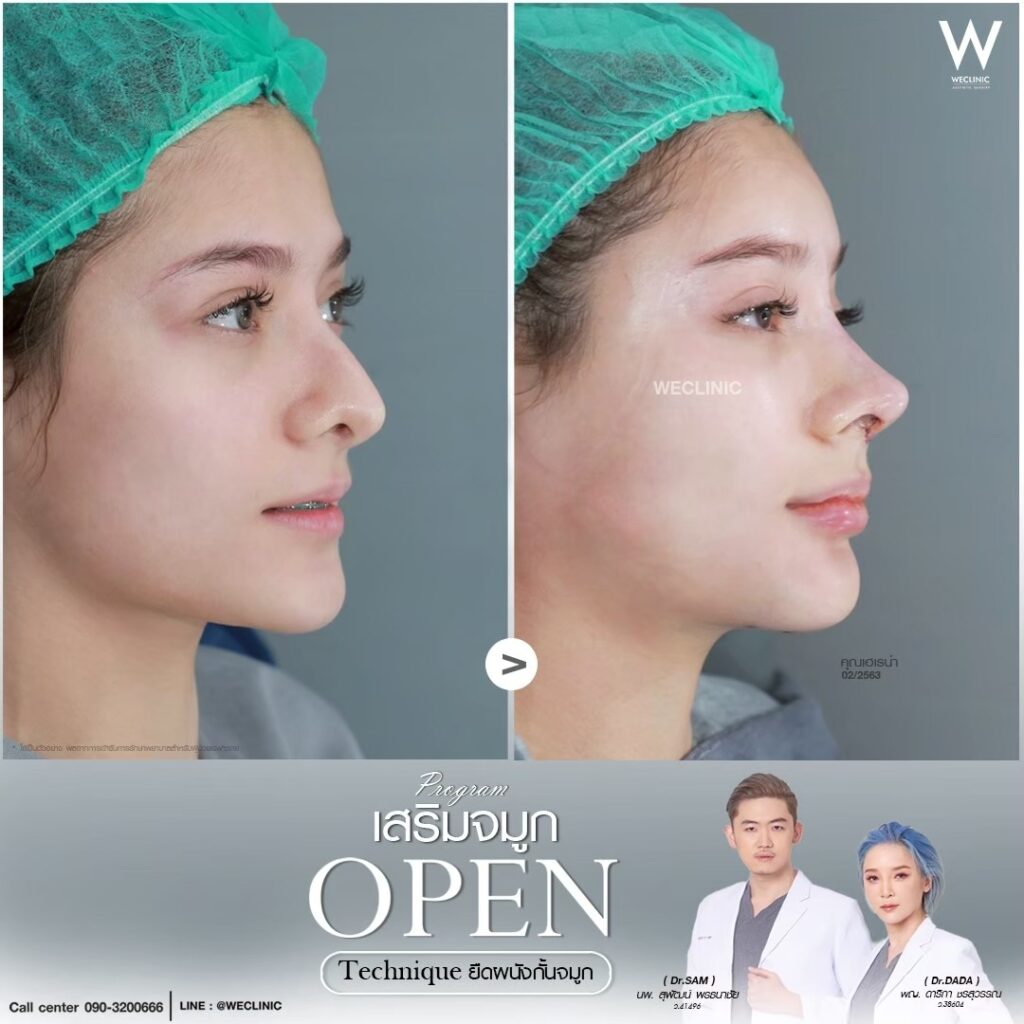 รีวิวเสริมจมูกโอเพ่น_เฮเรน่า_หมอดาด้า_หมอแซม
