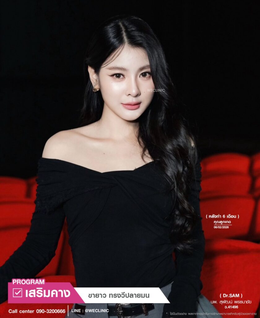 รีวิวโปรแกรมเสริมคาง 6 เดือน_คุณลูกเกด_หมอสุพัฒน์